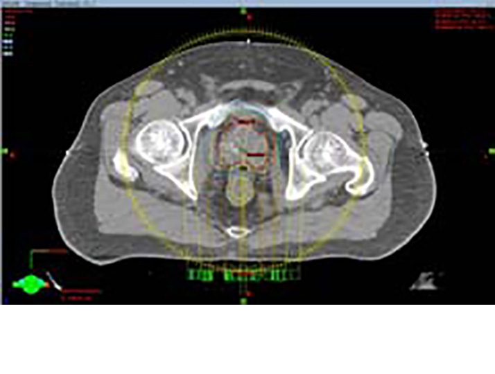 Research of optimization of radiotherapy treatment planning